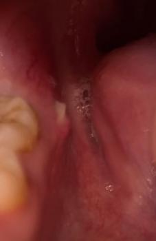 Gum abscess