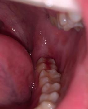 Bleeding gums