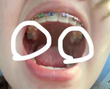 Brace irritation