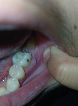 Tooth decay and gum infection