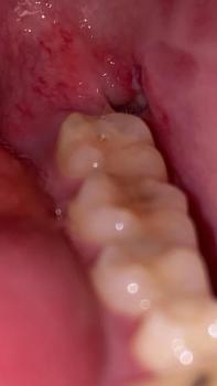 Dry socket